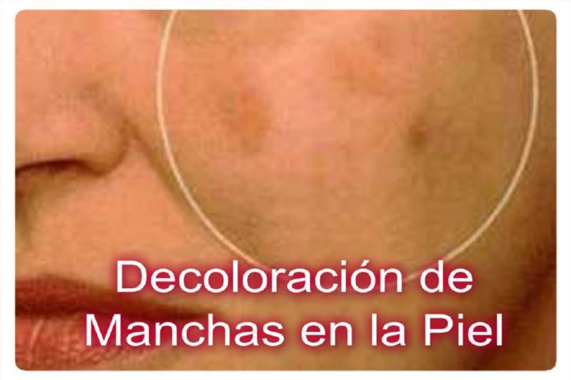 Decoloración de Manchas en la Piel
