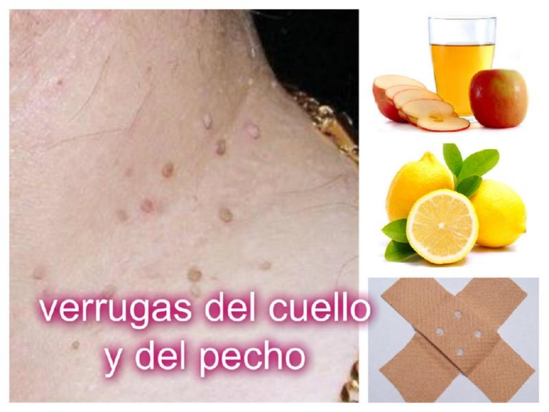 Eliminar de forma natural las verrugas del cuello y del pecho