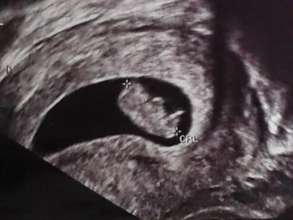 Ecografía primer trimestre de embarazo Fuente: Integra Salud Talavera
