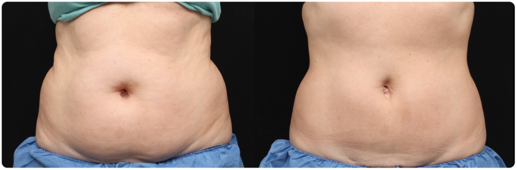 perder grasa abdominal