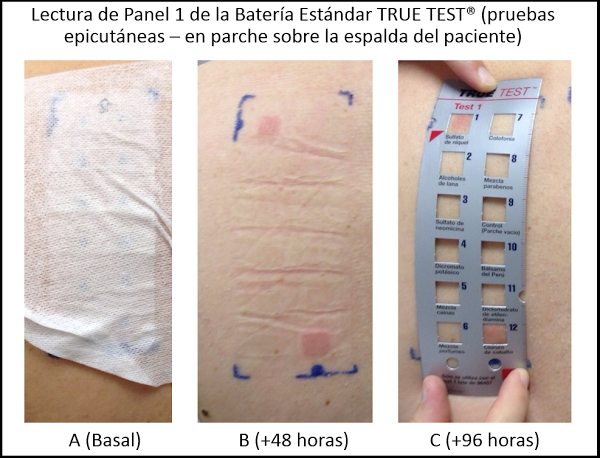 Lectura del Panel 1 de contactantes de la batería estándar TRUE TEST® de pruebas epicutáneas 