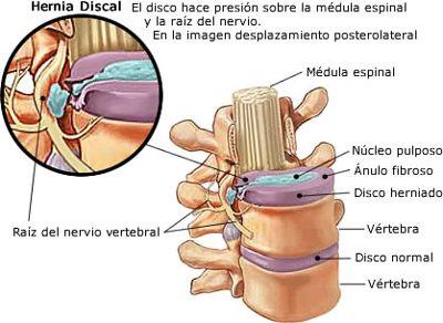 Hernia Discal