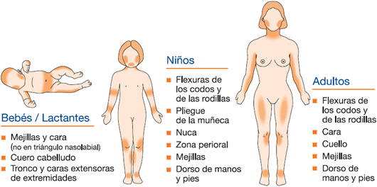 La dermatitis atópica