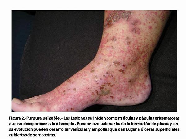Purpura palpable