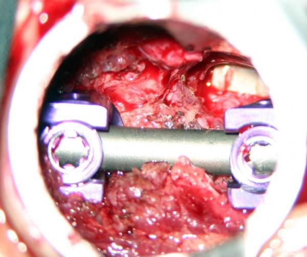 cirugia Fusión espinal