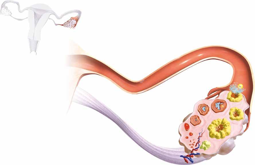 Ovario Poliquistico 3