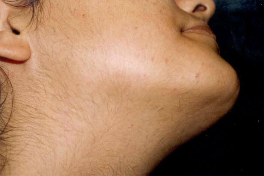 Ovario Poliquistico 5