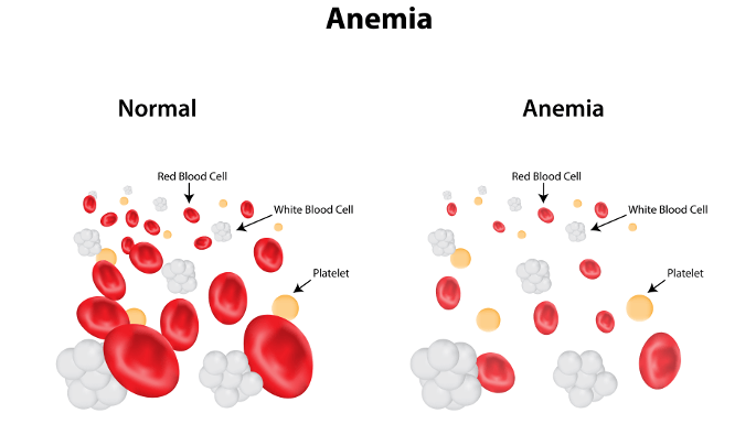 anemia 2