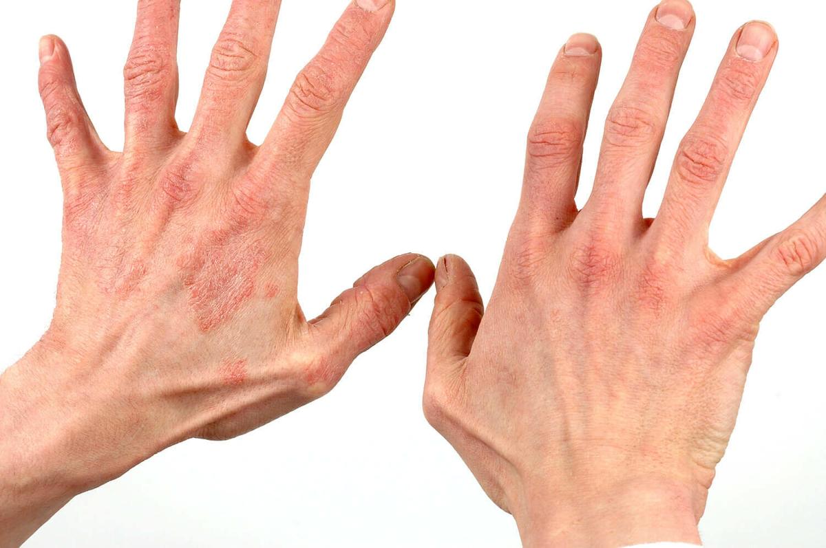 Dermatitis 1