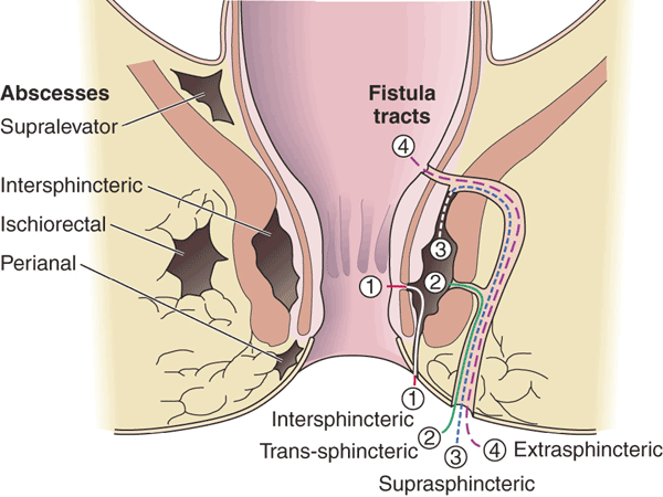 Fistula anal