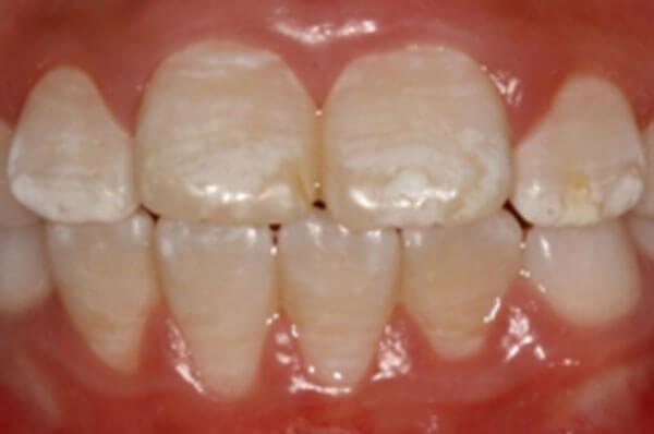 fluorosis niños