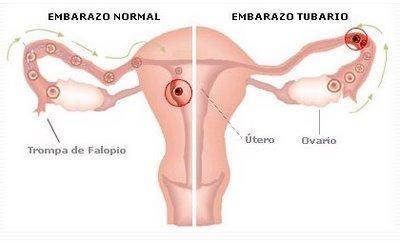 embarazo ectopico 2