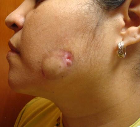 mordedura lesiones de piel