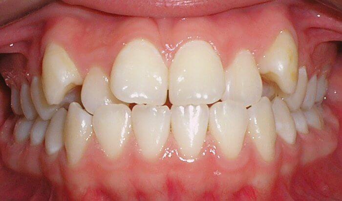 maloclusion