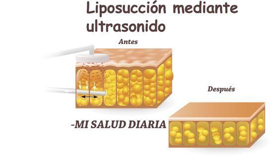 Celulitis