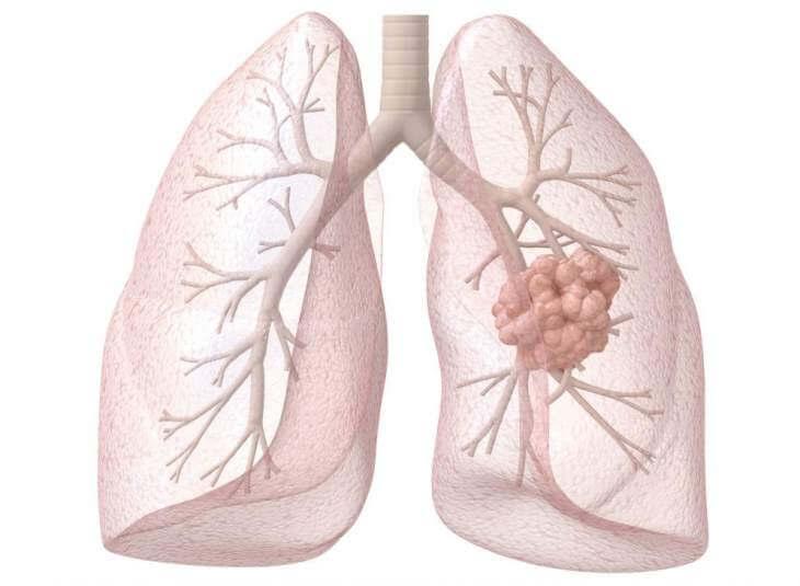 Cancer de Pulmon 2