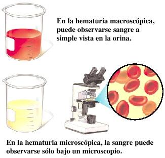 hematuria