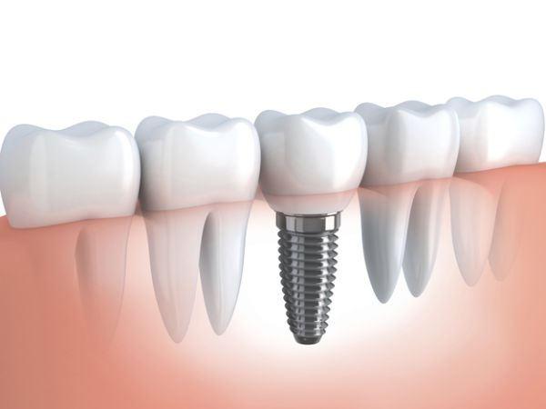 Como se hace un implante dental
