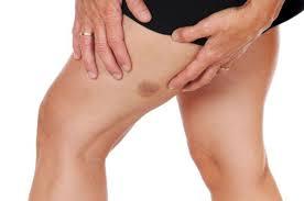 Cómo tratar los hematomas naturalmente