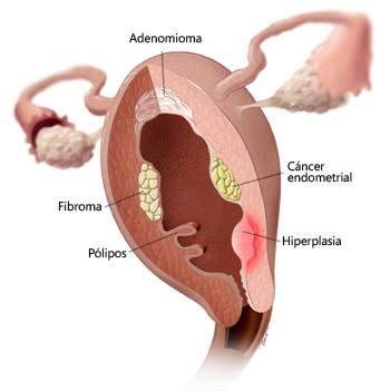 sangrado uterino