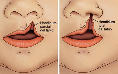 labio leporino