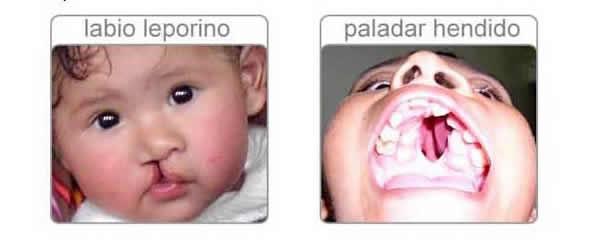 labio leporino