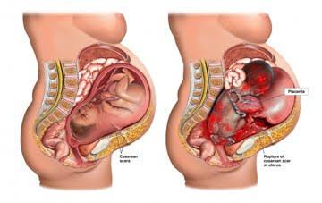distocias dinámicas 4