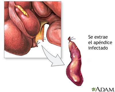 apendicitis