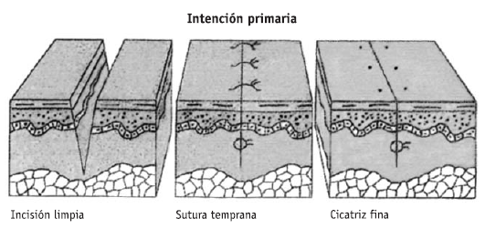 Cicatrización de heridas 2