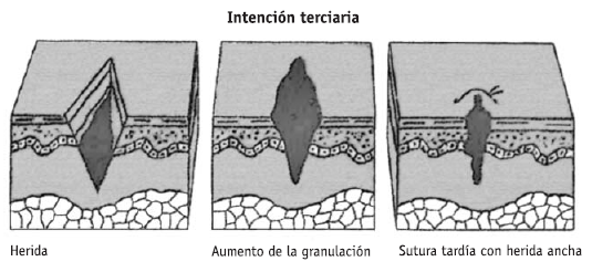 Cicatrización de heridas 4