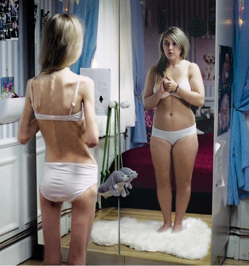 anorexia y bulimia