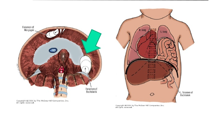 Hernia diafragmática congénita 2