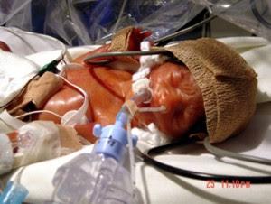 Hernia diafragmática congénita 3