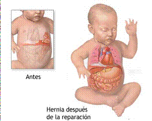 Hernia diafragmática congénita 4