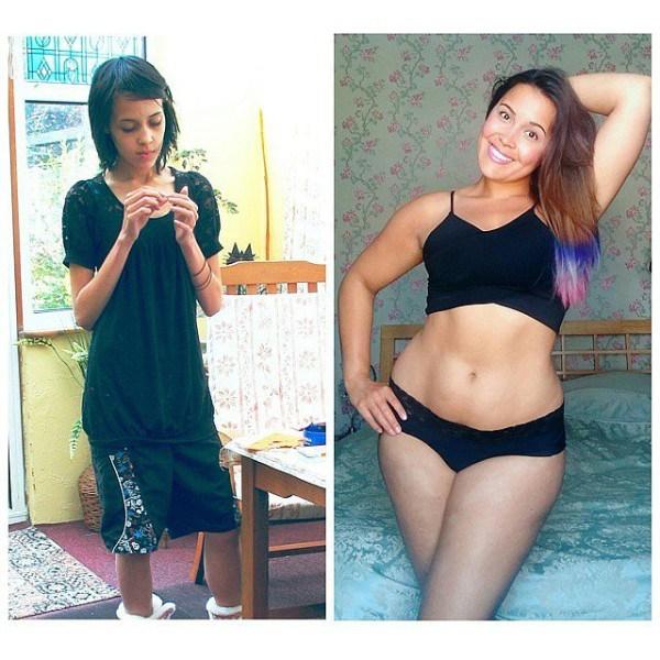 sobreviviente de la anorexia