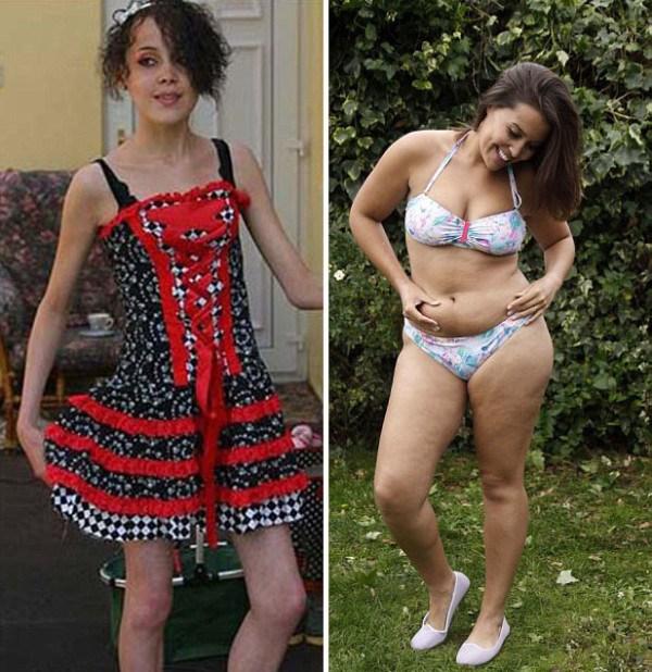sobreviviente a la anorexia