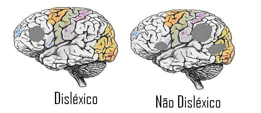 Cerebros Dislexicos