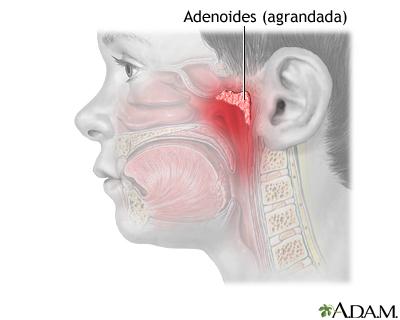 amigdalitis