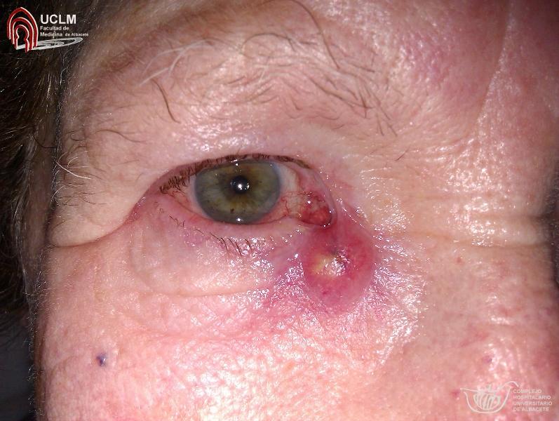 ojo rojo y doloroso 7