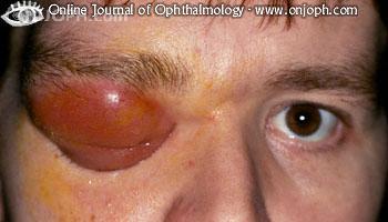 ojo rojo y doloroso 6