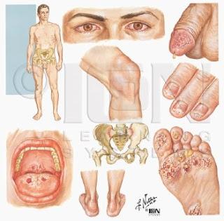 enfermedades de trasmision sexual