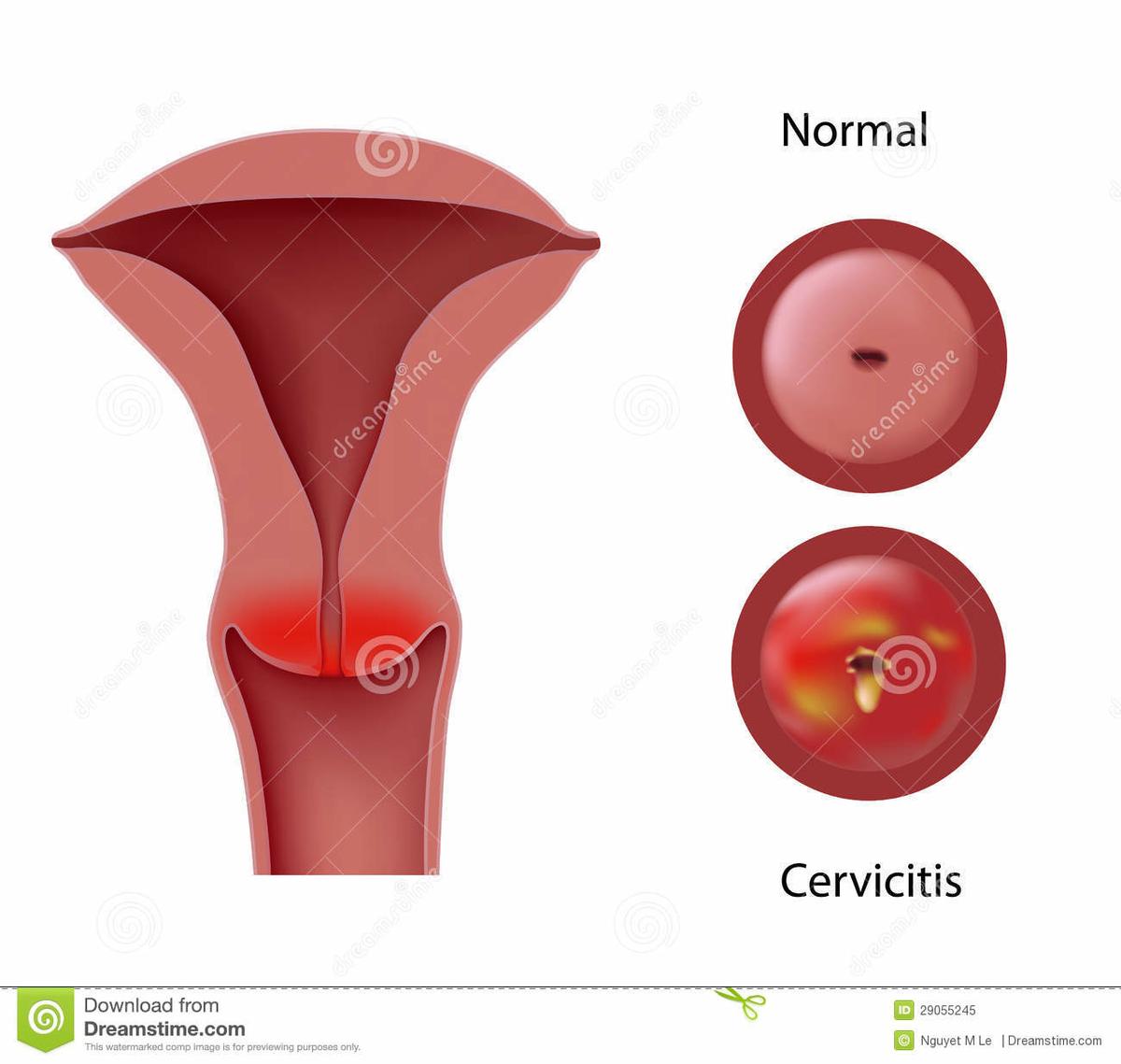 enfermedades de trasmision sexual