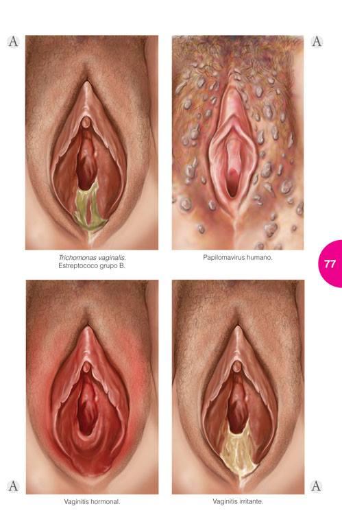 enfermedades de trasmision sexual