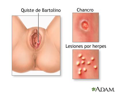 enfermedades de trasmision sexual