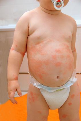 alergia