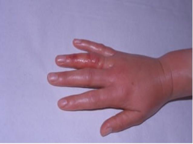 alergia