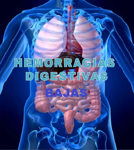 Hemorragia digestiva inferior