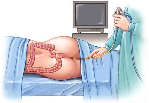 Hemorragia digestiva inferior 3