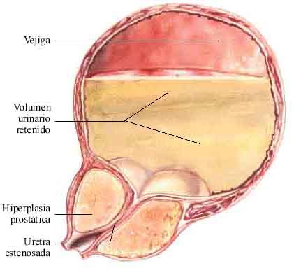 incontinencia urinaria