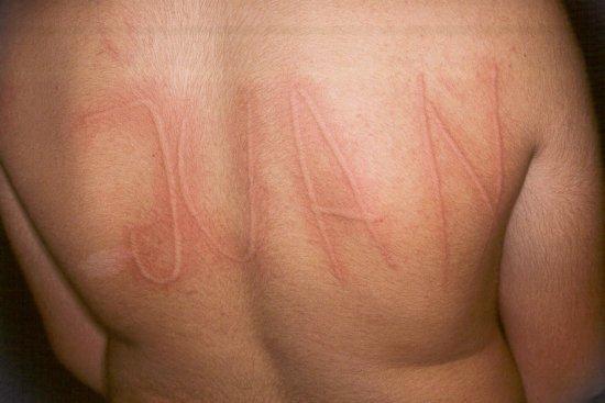 urticaria